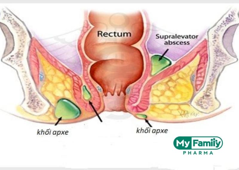 ÁP XE VÙNG HẬU MÔN, TRỰC TRÀNG LÀ GÌ VÀ CÁCH ĐIỀU TRỊ