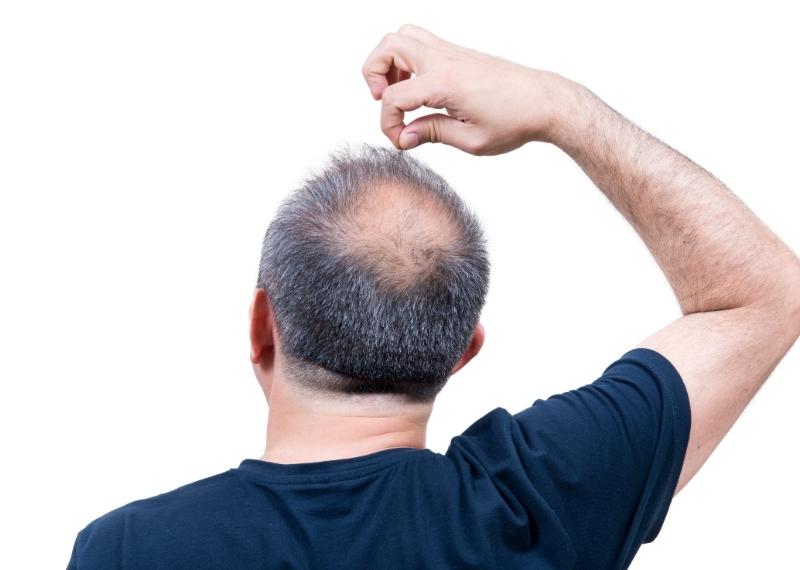Đàn ông hói đầu có phải liên quan đến vấn đề sinh lý?