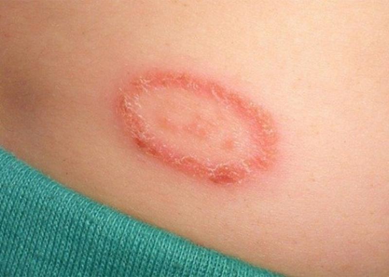 3 bệnh nấm da mùa hè thường gặp và biện pháp điều trị
