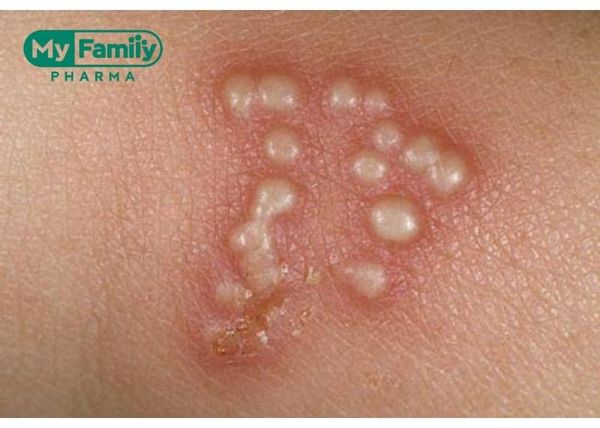 herpes sinh dục