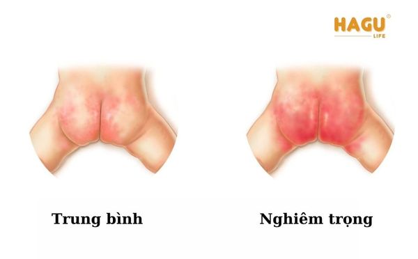 dấu hiệu dị ứng bỉm nặng ở trẻ