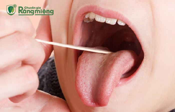 Không dùng tay chọc vỡ các cục trắng hôi trong miệng, dễ gây nhiễm trùng nguy hiểm