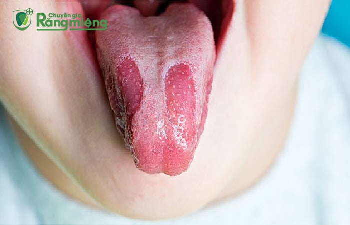 Tìm Hiểu Về Bệnh Nấm Lưỡi Bản Đồ Ở Trẻ Em