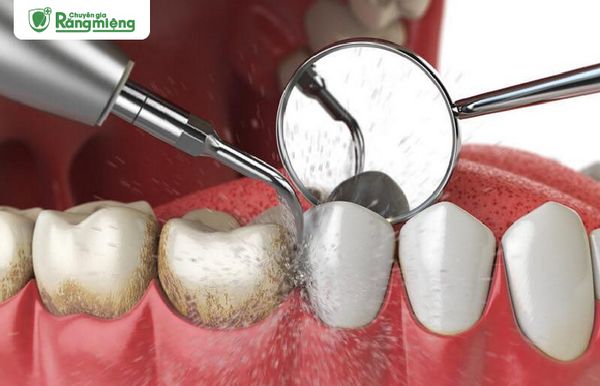 Cạo vôi răng định kỳ giúp loại bỏ môi trường phát triển của vi khuẩn