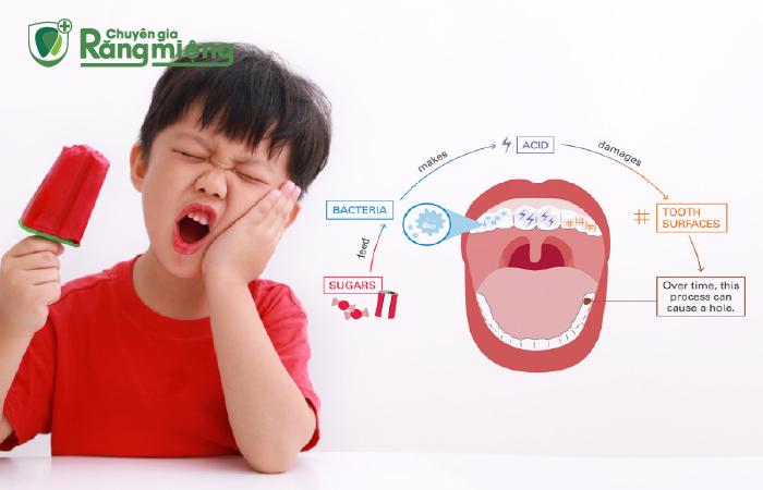 bệnh lý sâu răng ở trẻ em đang ngày càng phổ biến và gia tăng
