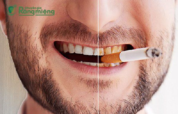 Hút thuốc lá gây vàng răng