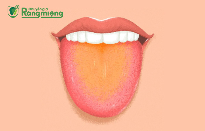 Triệu chứng bệnh lưỡi vàng có mùi hôi