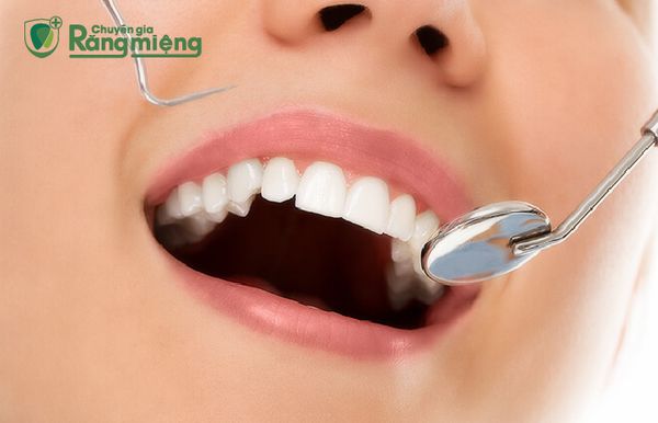 Tẩy trắng răng tại nha khoa
