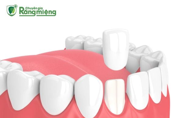 Răng sứ cần được chăm sóc kỹ lưỡng để kéo dài tuổi thọ