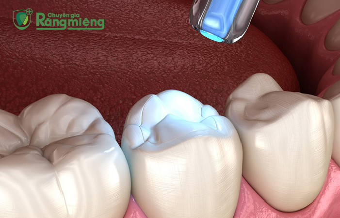 Trám răng là phương pháp thường được thực hiện để điều trị sâu răng trẻ em