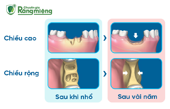 Hiện tượng mất răng, tiêu xương ổ răng khi em bé sâu răng nặng