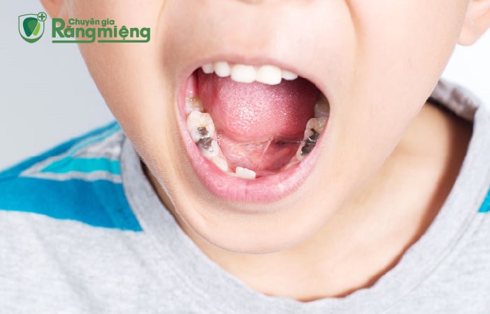 Sâu răng làm tăng nguy cơ mất răng ở trẻ nhỏ