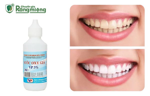 Sử dụng oxy già để làm trắng răng