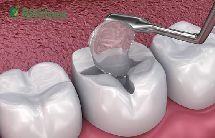 Trám răng là phương án chữa sâu răng cho trẻ 4 tuổi hiệu quả