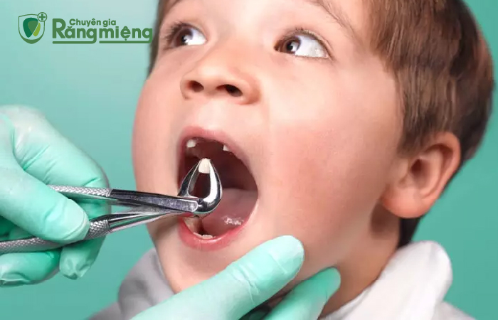 Trẻ 4 tuổi bị sâu răng hàm quá nặng, không thể phục hồi sẽ được nhổ bỏ