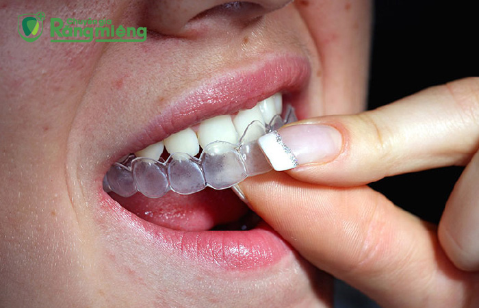Ưu và nhược điểm của phương pháp tẩy trắng răng bằng máng ngậm trắng răng