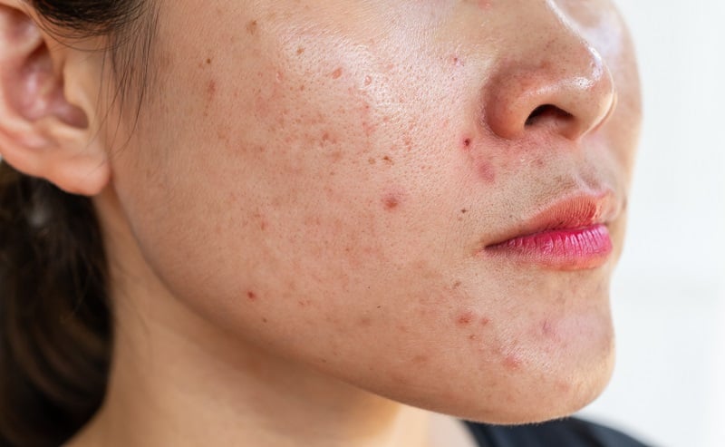 Da mụn nên skincare như thế nào để hiệu quả và an toàn?