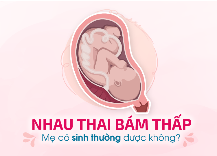 Nhau Thai Bám Thấp - Mẹ Có Sinh Thường Được Không?