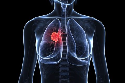 Tác dụng của dịch chiết Đông trùng Hạ thảo đối với ung thư phổi di căn ở chuột