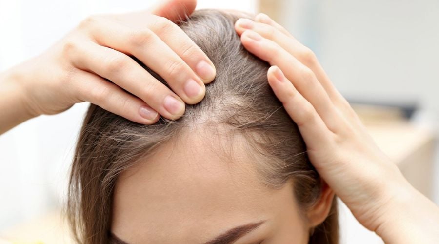 Nguyên nhân gây ra bệnh rụng tóc hói đầu ở nữ giới