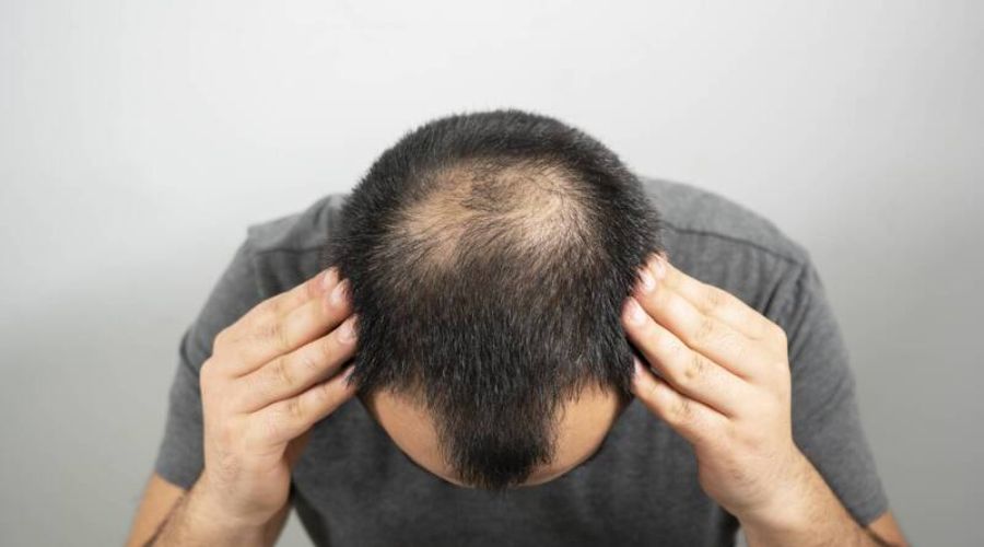 Rụng tóc ở đỉnh đầu nam giới Nguyên nhân  cách cải thiện  Rungtocvn