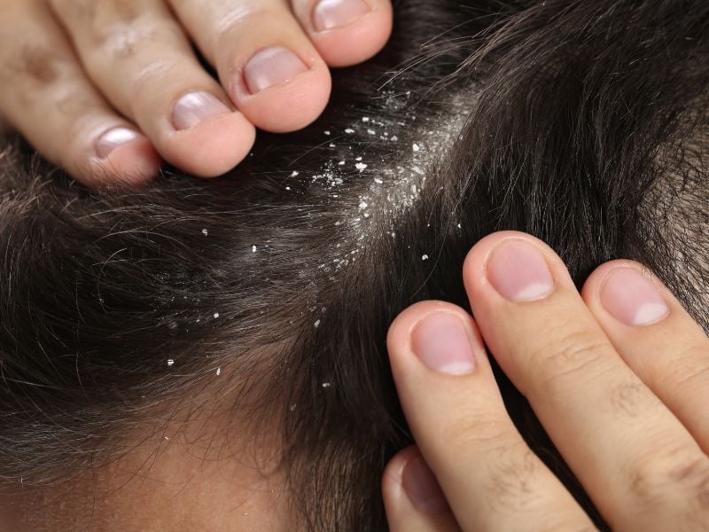 cách gội đầu không bị gàu