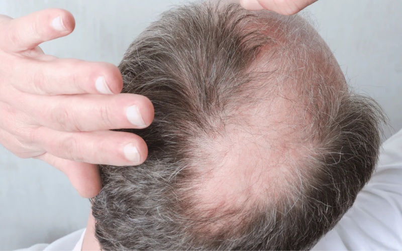 rụng tóc nhiều ở nữ là bệnh gì