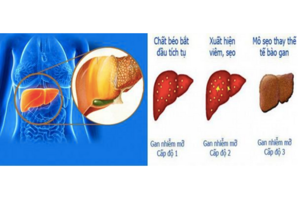 Bệnh gan nhiễm mỡ - Những diễn biến khó lường