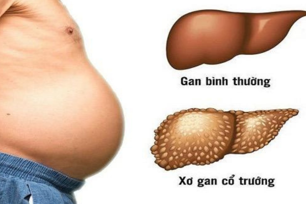 Cây Thuốc Chữa Bệnh Xơ Gan Cổ Trướng, Hỗ Trợ Điều Trị Gan