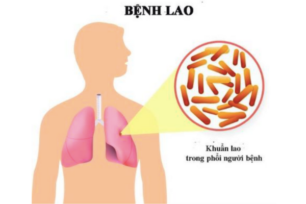 Bệnh lao phổi - Những thông tin bạn không nên bỏ qua