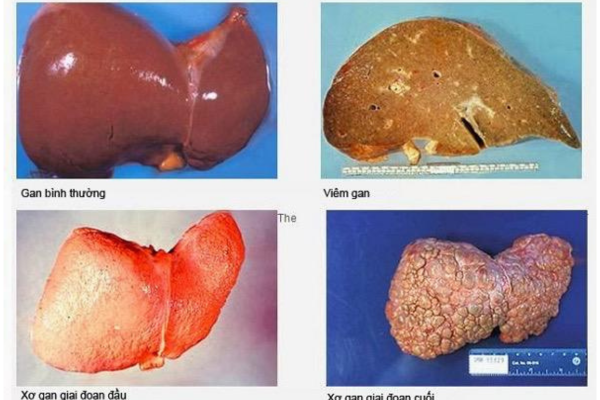 Bệnh xơ gan, những dấu hiệu bệnh gan, cách phòng chống bệnh xơ gan ...
