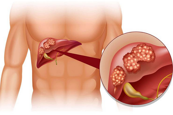 Biện pháp chăm sóc và điều trị cho bệnh nhân