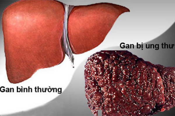 Bệnh gan giai đoạn cuối sống được bao lâu