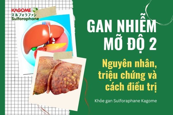 Gan nhiễm mỡ độ 2? Nguyên nhân, triệu chứng và cách điều trị