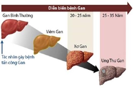 “Dấu hiệu của bệnh gan là gì?” Những biểu hiện thường gặp của bệnh gan