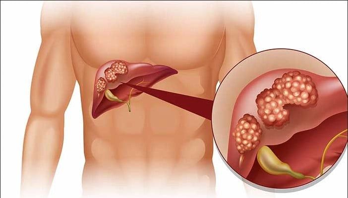 Các phương pháp đơn giản để kiểm tra sức khỏe gan tại nhà