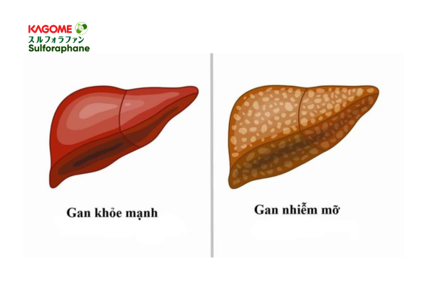 Thuốc điều trị gan nhiễm mỡ độ 2 tốt nhất hiện nay