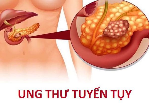 ung-thu-tuyen-tuy