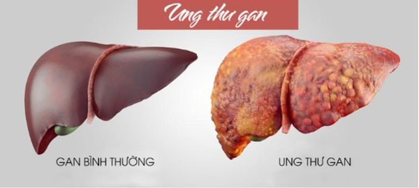 Bệnh ung thư gan có chữa được không?