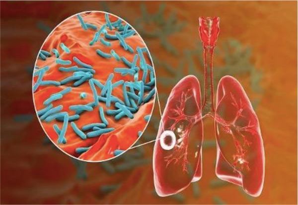 Cách điều trị bệnh lao phổi