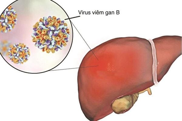 Điều trị bệnh viêm gan B