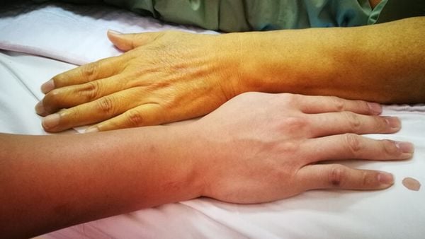 tác nhân gây ra bệnh viêm gan a là gì