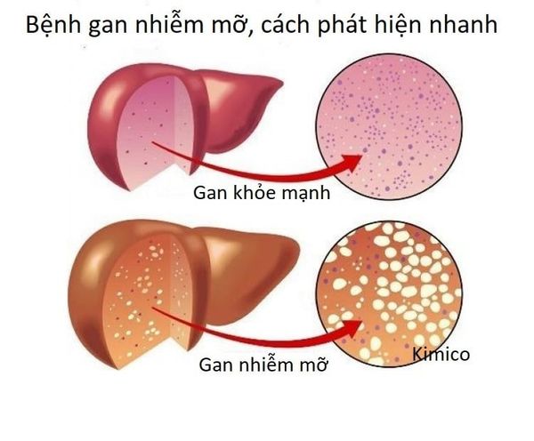 dau-hieu-nhan-biet-gan-nhiem-mo