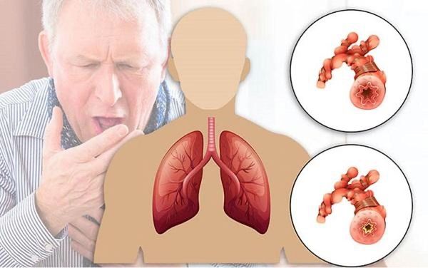 Các bệnh về đường hô hấp thường gặp hiện nay