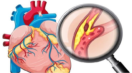 Bệnh mạch vành gây ra nguy cơ tổn thương tim