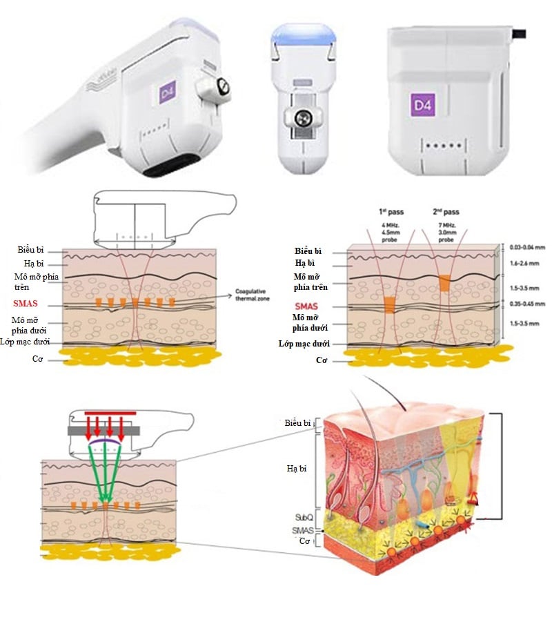 Máy nâng cơ SMAS HIFU
