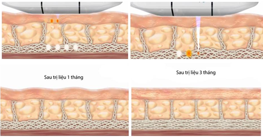 Máy nâng cơ SMAS HIFU