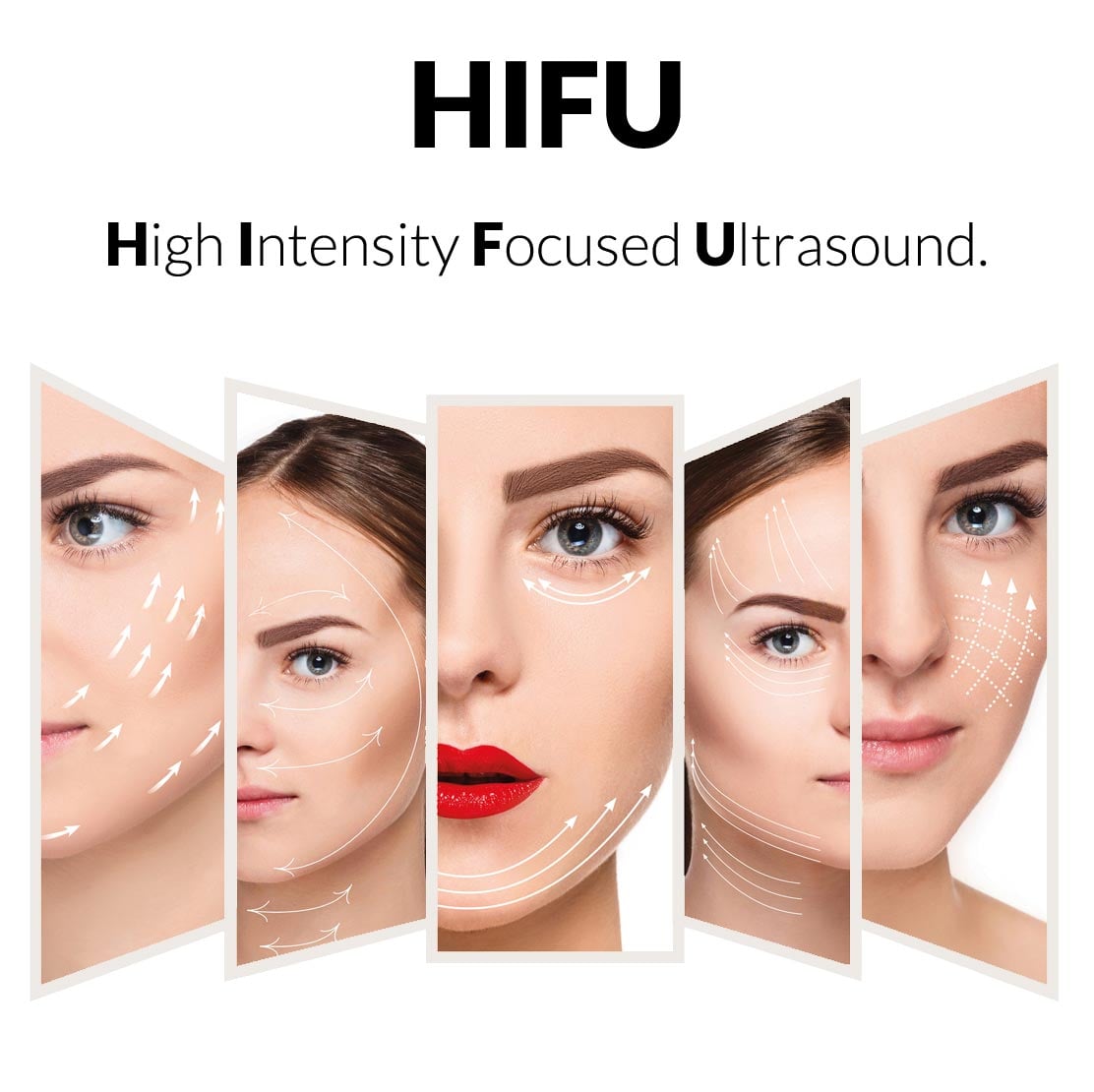 Máy nâng cơ SMAS HIFU