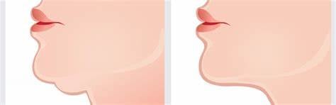 Máy nâng cơ SMAS HIFU