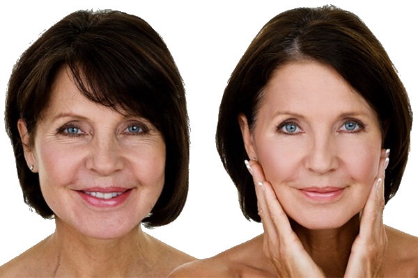 Máy nâng cơ SMAS HIFU